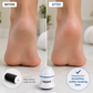 HeelNova™ Removes calluses effortlessly.